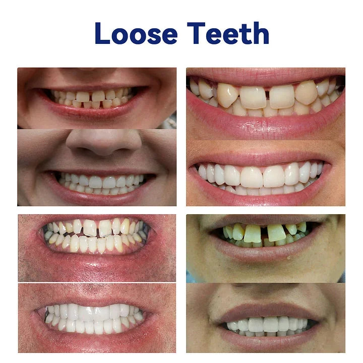 Denture Set Flexible Waterproof Upper & Lower